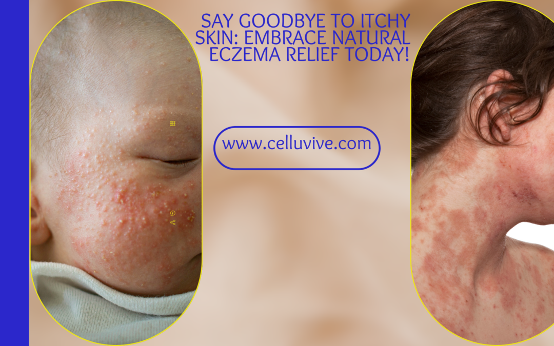 Top Naturopathic Treatments for Eczema Relief