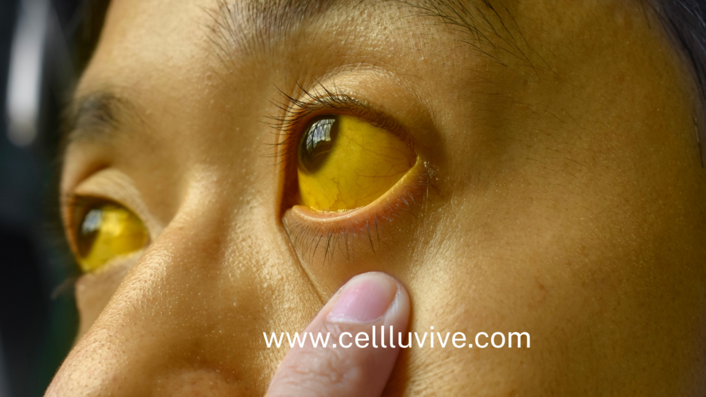 image of an eye with jaundice, a symptom of liver disease